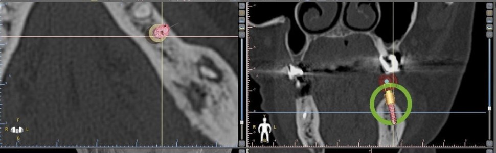 Implantologia wspomagana komputerowo