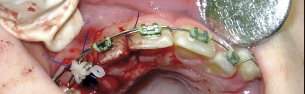 Leczenie chirurgiczno-ortodontyczne zatrzymanych kłów