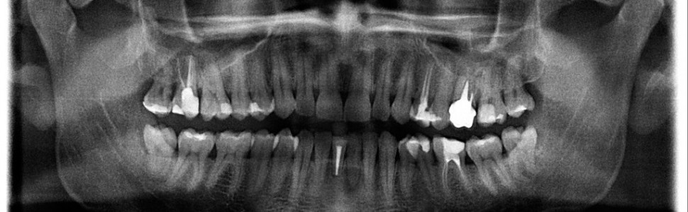 Trudne sytuacje w endodoncji