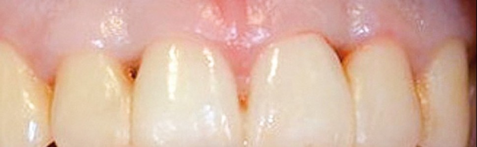 Wykorzystanie kwasu hialuronowego w periodontologii 