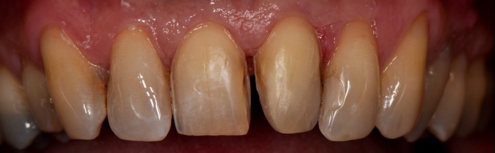 Rekonstrukcja tkanek zębów przednich po urazie z wykorzystaniem licówek ceramicznych 