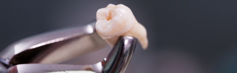 Jatrogenne złamanie żuchwy spowodowane usunięciem trzeciego zęba trzonowego. Czy można mu zapobiec?