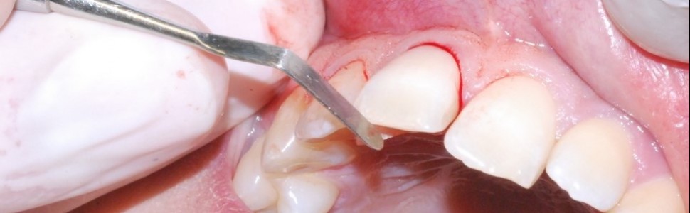 Pourazowa odbudowa zęba siecznego przyśrodkowego szczęki z wykorzystaniem odłamanego zrębu