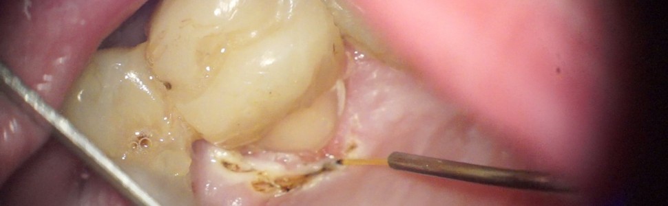 Rozwiązanie problemu złamania poddziąsłowego korony zęba przedtrzonowego – opis dwóch przypadków