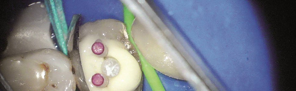  Rozwiązanie problemu złamania poddziąsłowego korony zęba przedtrzonowego – opis dwóch przypadków