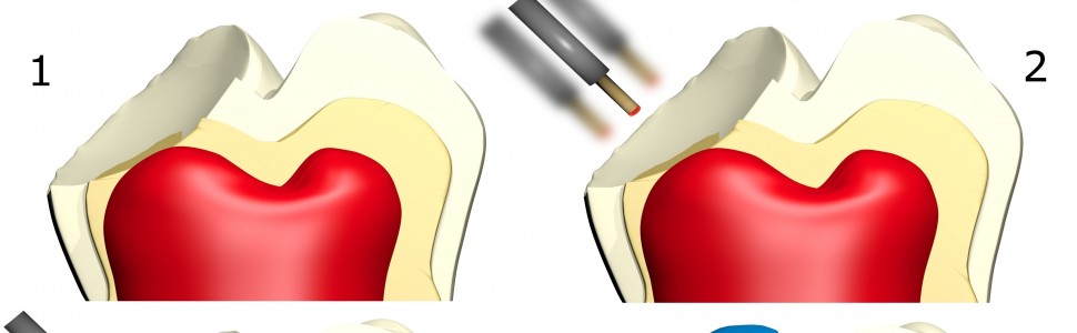 Laseroterapia jako skuteczne uzupełnienie procedur terapeutycznych w leczeniu endodontycznym