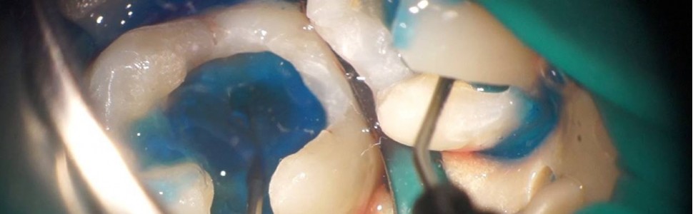 Zastosowanie dezynfekcji fotoaktywnej w leczeniu próchnicy zębów