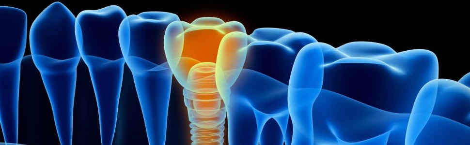 Przedzabiegowa ocena miejsc wszczepienia implantów z wykorzystaniem pantomografii i stożkowej tomografii komputerowej – wpływ specjalizacji medycznej