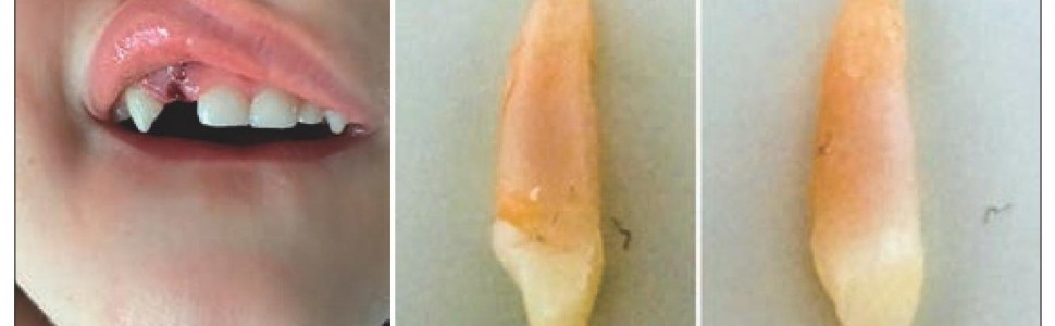 Jak należy postąpić w przypadku wybicia zęba mlecznego?