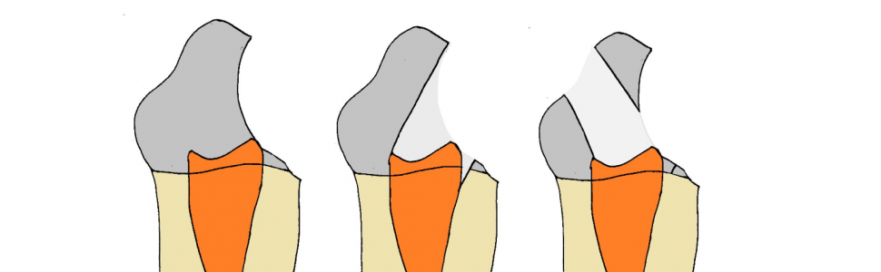 Nietypowa lokalizacja dostępu do jamy zęba