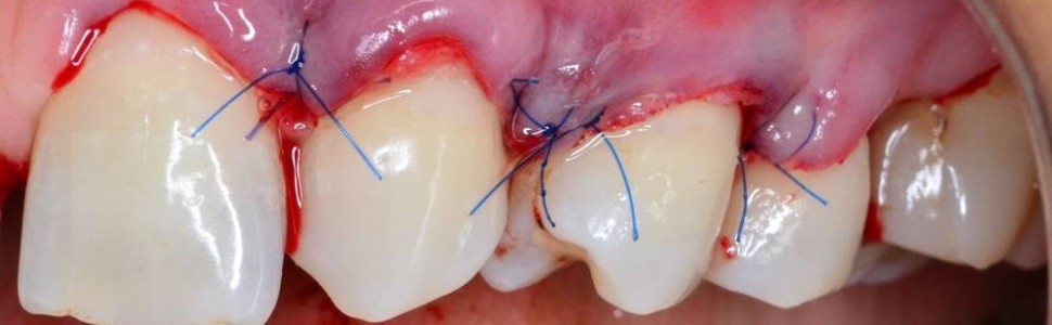 Jak postąpić w przypadku recesji dziąsłowych?