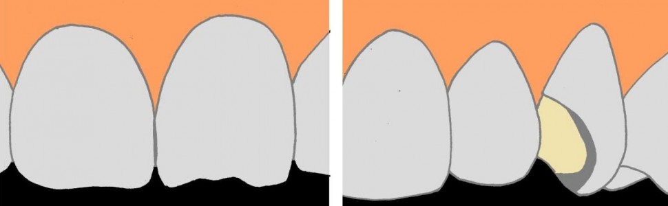 Jak postąpić z uszkodzoną licówką porcelanową?