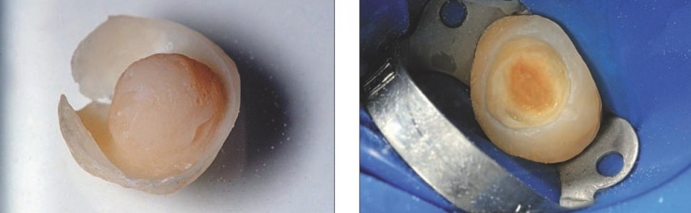 Odbudowa zęba trzonowego metodą półpośrednią