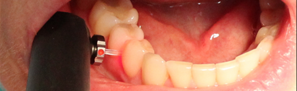 Diagnostyka próchnicy nieubytkowej
