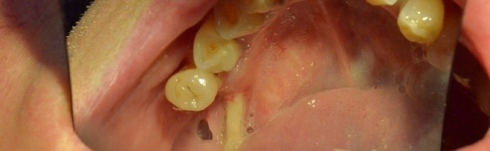 Czy ekstrakcje zębów u pacjentów w trakcie terapii bisfosfonianami są przeciwwskazane?