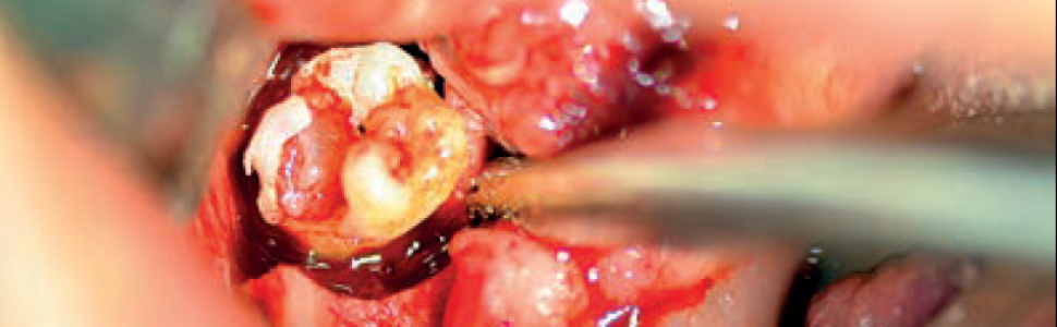 Zatrzymany ząb mądrości w atroficznej żuchwie przyczyną ropnia przestrzeni przygardłowej u pacjenta geriatrycznego. Opis przypadku