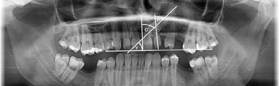 Resorpcja korzeni zębów sąsiadujących z zatrzymanym kłem – przegląd piśmiennictwa. Część I