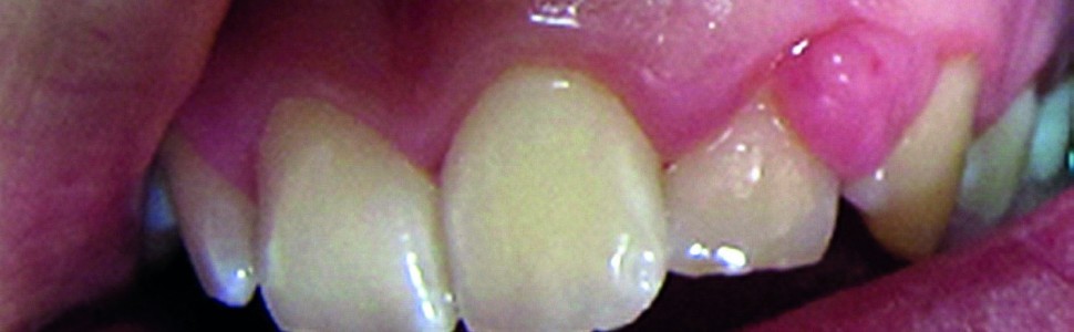 Najczęściej występujące zmiany w jamie ustnej u kobiet w ciąży. Zalecenia higieniczno‑dietetyczne − przegląd piśmiennictwa