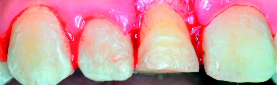 Wielospecjalistyczne leczenie estetyczne skośnego koronowo‑korzeniowego złamania zęba siecznego przyśrodkowego. Opis przypadku