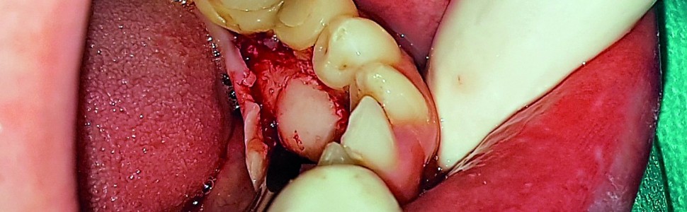 Mnogie kostniaki obwodowe żuchwy. Opis przypadku