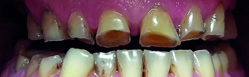 Starcie zębów – współczesny problem stomatologiczny