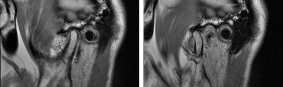 Diagnostyka obrazowa stawów skroniowo-żuchwowych z wykorzystaniem stożkowej tomografii komputerowej i obrazowania metodą rezonansu magnetycznego 