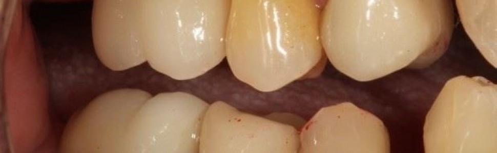 Zapobieganie przeciążeniu zgryzowemu za pomocą nowoczesnych technologii jako sposób na przedłużenie żywotności prac protetycznych opartych na implantach