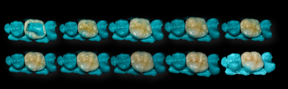 REPORTAŻ KLINICZNY. Uproszczona technika półpośrednia wykonania nakładów kompozytowych w gabinecie stomatologicznym