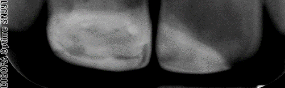 Rewaskularyzacja – postępowanie kliniczne