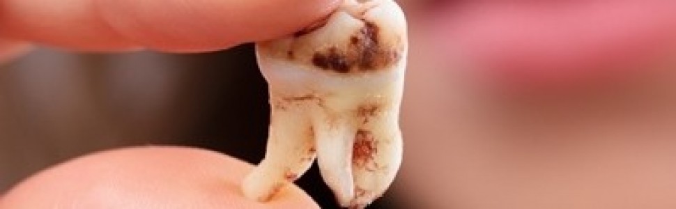 Analiza częstości występowania próchnicy korzenia u osób powyżej 65. roku życia