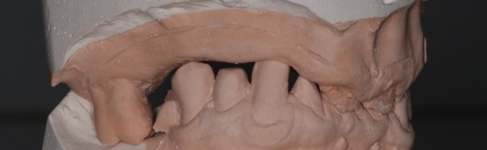 Rekonstrukcja uzębienia u pacjenta z obniżoną wysokością zwarcia. Opis przypadku