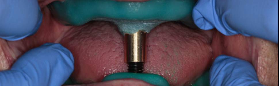 Ocena skuteczności ustalania zgryzu metodą ćwieka centralnego