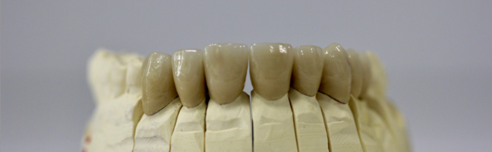 Rehabilitacja protetyczna pacjenta z zaawansowanym patologicznym starciem zębów i głębokimi ubytkami klinowymi – charakterystyka, etiologia, opis przypadku