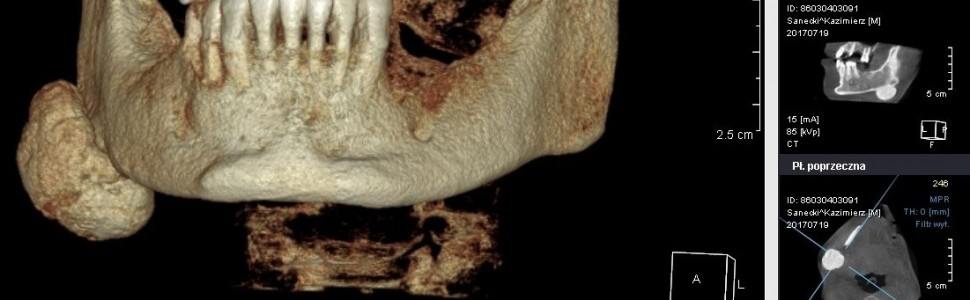 Kostniak żuchwy – opis przypadku