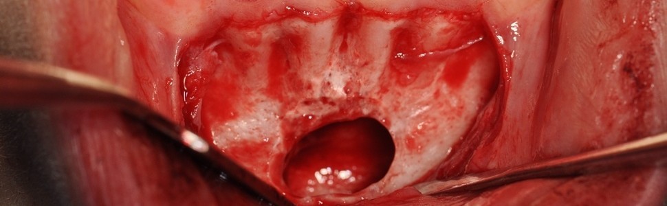 Torbiel samotna okolicy pośrodkowej trzonu żuchwy – obraz kliniczny i leczenie. Opis przypadku