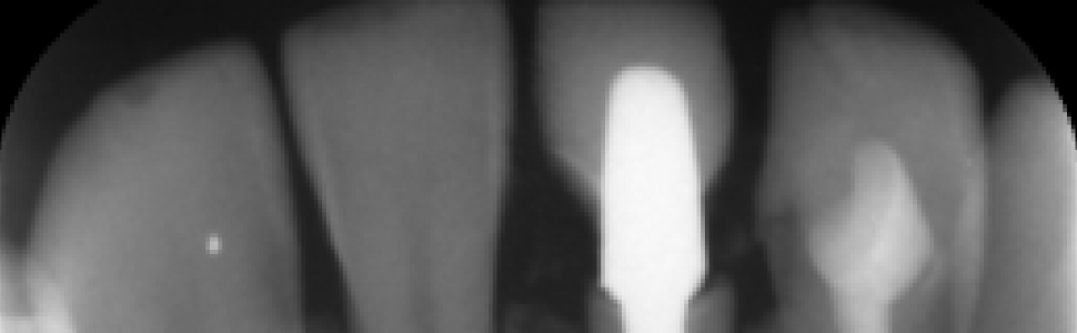 Wiarygodność badań pantomograficznych – odcinek przedni w żuchwie