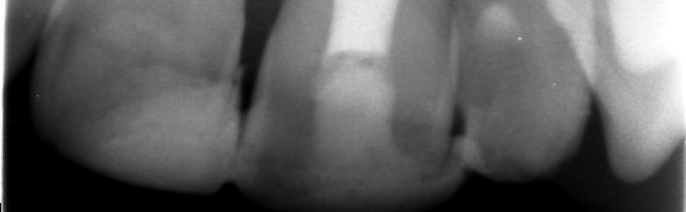 Radiologiczny obraz tkanek okołowierzchołkowych i przyzębia brzeżnego zęba po replantacji – obserwacje kilkunastomiesięczne. Opis przypadku