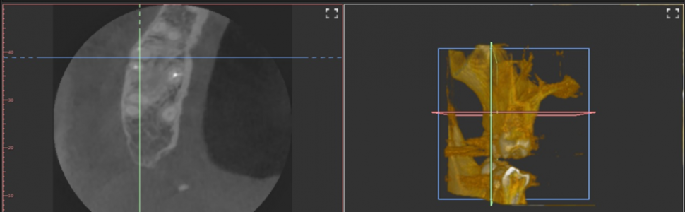 Ograniczenia zdjęć zębowych w diagnostyce okołowierzchołkowych zmian zapalnych. Opis przypadku