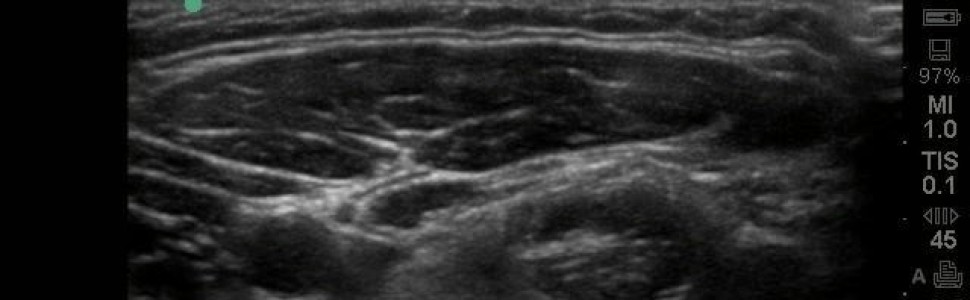 Zastosowanie ultrasonografii w monitorowaniu postępów leczenia zaburzeń czynnościowych narządu żucia