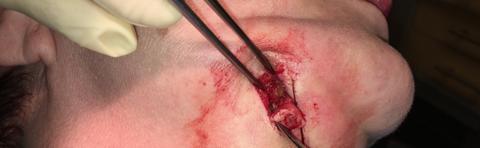 Zębopochodna przetoka zewnątrzustna okolicy podżuchwowej – opis przypadku