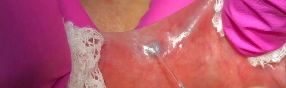 Zastosowanie lasera diodowego PRIMO® o długości fali 810 nm w leczeniu naczyniaka i włókniaka na błonie śluzowej jamy ustnej – opisy przypadków