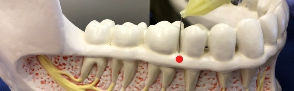 Skuteczne znieczulenie śródwięzadłowe z zastosowaniem systemów do znieczuleń komputerowych