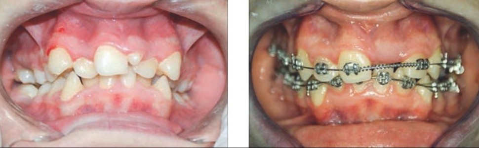 Hiperdoncja w odcinku przednim szczęki i żuchwy – przegląd piśmiennictwa i przypadków własnych