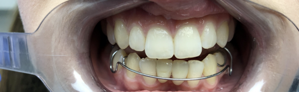 Późna replantacja dwóch zębów – opis przypadku