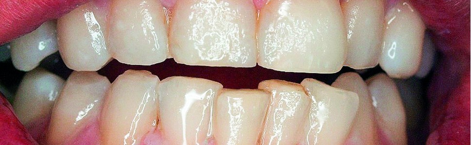 Przegląd lakierów fluorowych