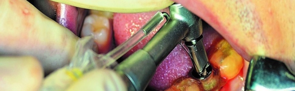 Zabieg implantacji natychmiastowej w żuchwie przeprowadzony przy użyciu nawigacji komputerowej i szablonu chirurgicznego