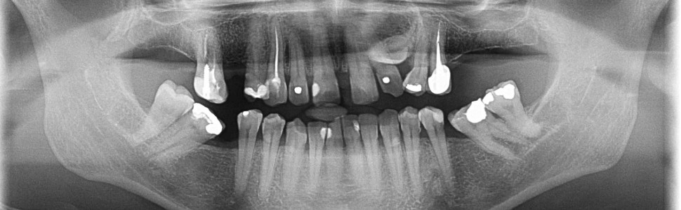 Postępowanie ortodontyczno‑implantologiczne w trudnym przypadku zatrzymania kła w szczęce