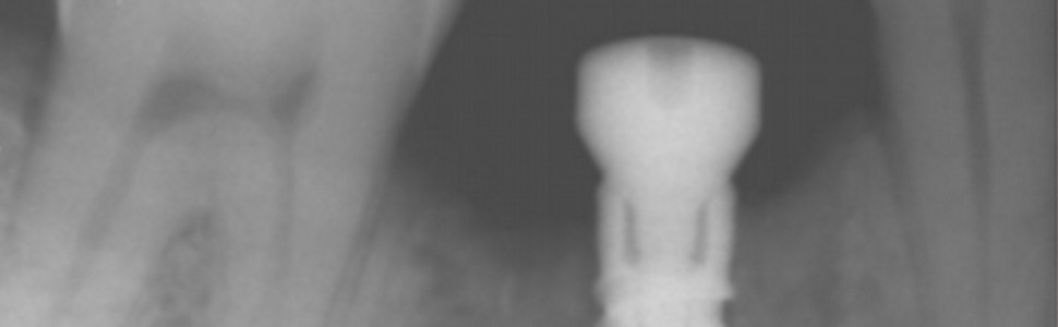 Wprowadzenie wszczepu śródkostnego w odcinku bocznym żuchwy z użyciem szablonu implantologicznego 