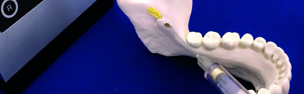 Nowe możliwości znieczuleń  podniebiennych i przewodowych  żuchwy dzięki systemom do komputerowego podawania znieczuleń (CCLAD)