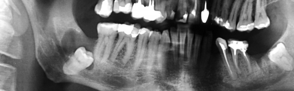 Leczenie chirurgiczne  torbieli zawiązkowej żuchwy związanej z zębem 48 – opis przypadku